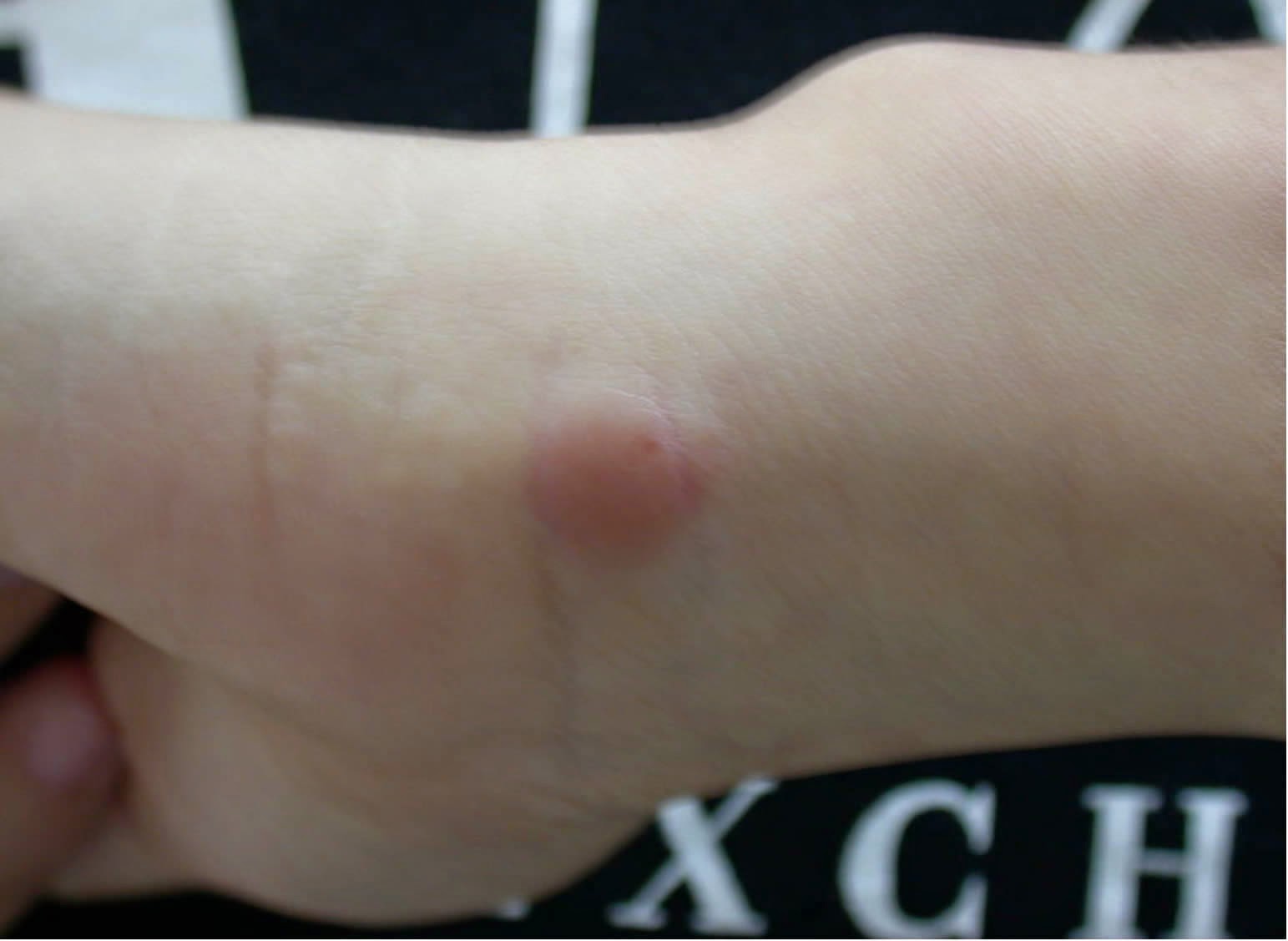 ENFERMEDAD DE BESNIERBOECKSCHAUMANN PDF